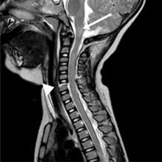 MRI Screening OF Throat